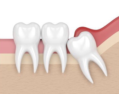 RREMOVAL OF PREGROWN TISSUES